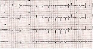 Resultado de imagen para fibrilacion auricular